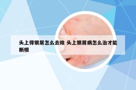 头上得银屑怎么去除 头上银屑病怎么治才能断根