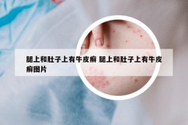腿上和肚子上有牛皮癣 腿上和肚子上有牛皮癣图片