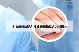 牛皮癣精油配方 牛皮癣精油配方20种图片