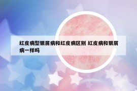 红皮病型银屑病和红皮病区别 红皮病和银屑病一样吗