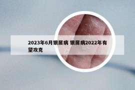 2023年6月银屑病 银屑病2022年有望攻克