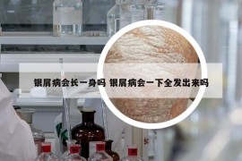银屑病会长一身吗 银屑病会一下全发出来吗