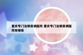 重庆专门治银屑病医院 重庆专门治银屑病医院有哪些