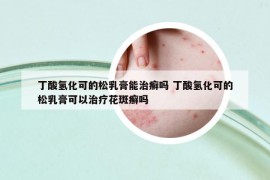 丁酸氢化可的松乳膏能治癣吗 丁酸氢化可的松乳膏可以治疗花斑癣吗