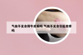 气血不足会得牛皮癣吗 气血不足会引起皮疹吗