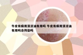 牛皮有癣用清凉油有用吗 牛皮有癣用清凉油有用吗会传染吗