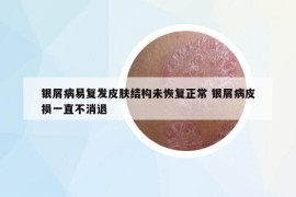 银屑病易复发皮肤结构未恢复正常 银屑病皮损一直不消退