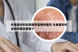 长春最好的皮肤医院是哪所医院 长春最好的皮肤科医院是哪个