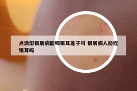 点滴型银屑病能喝银耳莲子吗 银屑病人能吃银耳吗