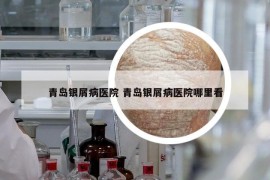 青岛银屑病医院 青岛银屑病医院哪里看