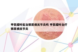 甲氨蝶呤能治银屑病关节炎吗 甲氨蝶呤治疗银屑病关节炎
