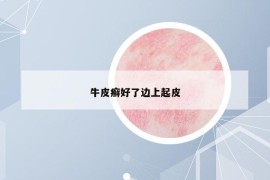 牛皮癣好了边上起皮