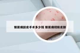 银屑病刮皮手术多少钱 银屑病切除皮肤