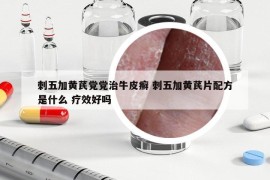 刺五加黄芪党党治牛皮癣 刺五加黄芪片配方是什么 疗效好吗