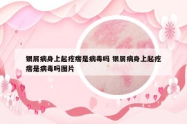 银屑病身上起疙瘩是病毒吗 银屑病身上起疙瘩是病毒吗图片