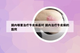 国内哪里治疗牛皮癣最好 国内治疗牛皮癣的医院