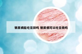 银屑病能吃豆鼓吗 银屑病可以吃豆类吗