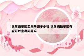 银屑病基因监测基因多少钱 银屑病做基因筛查可以查出问题吗