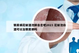 银屑病花椒酒泡脚自愈吧2023 花椒泡白酒可以治银屑病吗
