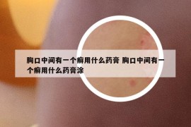 胸口中间有一个癣用什么药膏 胸口中间有一个癣用什么药膏涂