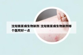 沈阳银屑病生物制剂 沈阳银屑病生物制剂哪个医院好一点