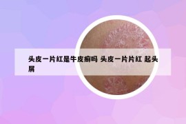 头皮一片红是牛皮癣吗 头皮一片片红 起头屑