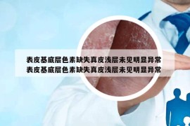 表皮基底层色素缺失真皮浅层未见明显异常 表皮基底层色素缺失真皮浅层未见明显异常