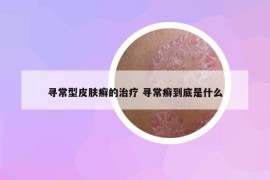 寻常型皮肤癣的治疗 寻常癣到底是什么