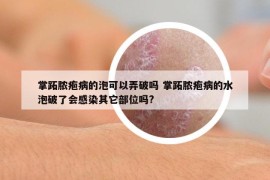 掌跖脓疱病的泡可以弄破吗 掌跖脓疱病的水泡破了会感染其它部位吗?