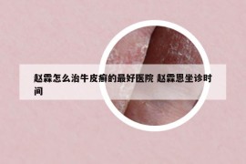 赵霖怎么治牛皮癣的最好医院 赵霖恩坐诊时间