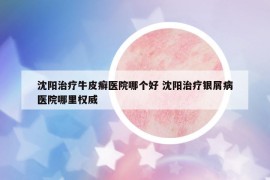 沈阳治疗牛皮癣医院哪个好 沈阳治疗银屑病医院哪里权威