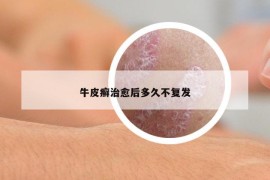 牛皮癣治愈后多久不复发