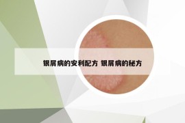 银屑病的安利配方 银屑病的秘方
