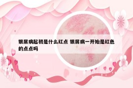 银屑病起初是什么红点 银屑病一开始是红色的点点吗