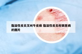 脂溢性皮炎又叫牛皮癣 脂溢性皮炎和银屑病的图片