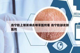南宁脸上银屑病去哪家医院看 南宁脸部皮肤医院