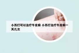 小苏打可以治疗牛皮癣 小苏打治疗牛皮癣一天几次