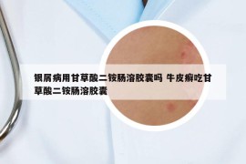 银屑病用甘草酸二铵肠溶胶囊吗 牛皮癣吃甘草酸二铵肠溶胶囊