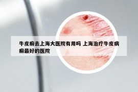牛皮癣去上海大医院有用吗 上海治疗牛皮病癣最好的医院