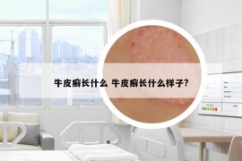 牛皮癣长什么 牛皮癣长什么样子?