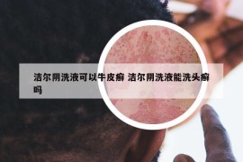 洁尔阴洗液可以牛皮癣 洁尔阴洗液能洗头癣吗