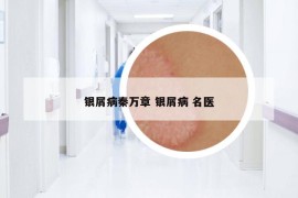 银屑病秦万章 银屑病 名医