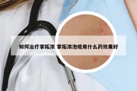 如何冶疗掌拓浓 掌拓浓泡疮用什么药效果好