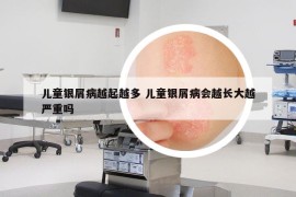 儿童银屑病越起越多 儿童银屑病会越长大越严重吗