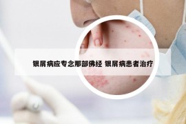 银屑病应专念那部佛经 银屑病患者治疗
