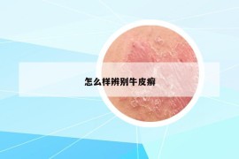 怎么样辨别牛皮癣