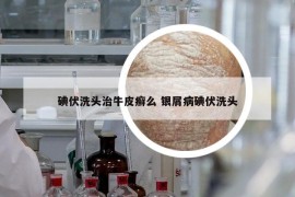 碘伏洗头治牛皮癣么 银屑病碘伏洗头