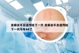 皮癣会不会遗传给下一代 皮癣会不会遗传给下一代今年44了
