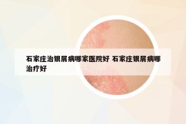 石家庄治银屑病哪家医院好 石家庄银屑病哪治疗好
