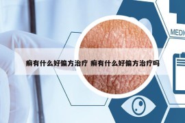 癣有什么好偏方治疗 癣有什么好偏方治疗吗